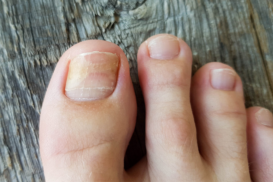 Wat te doen tegen nagelschimmel? 
