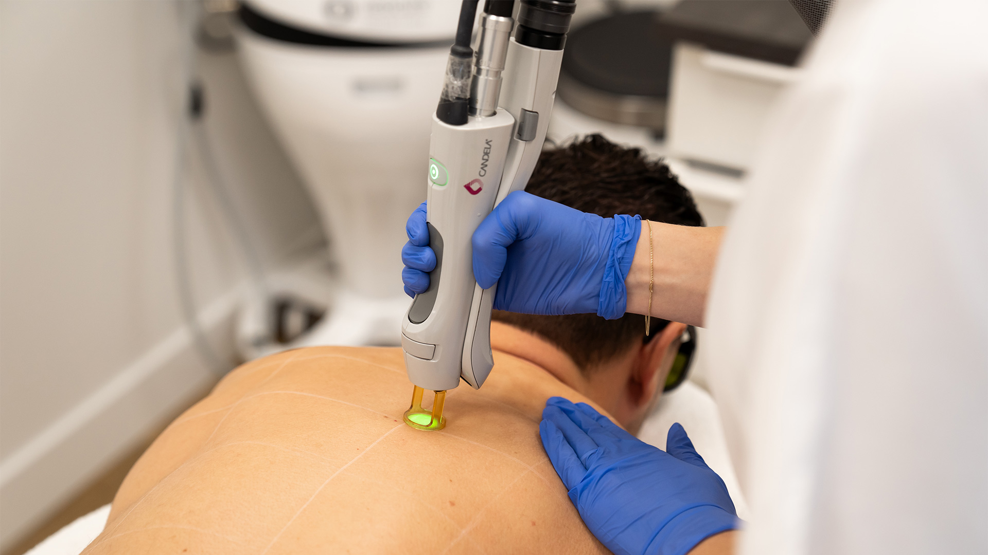 Laserontharing
