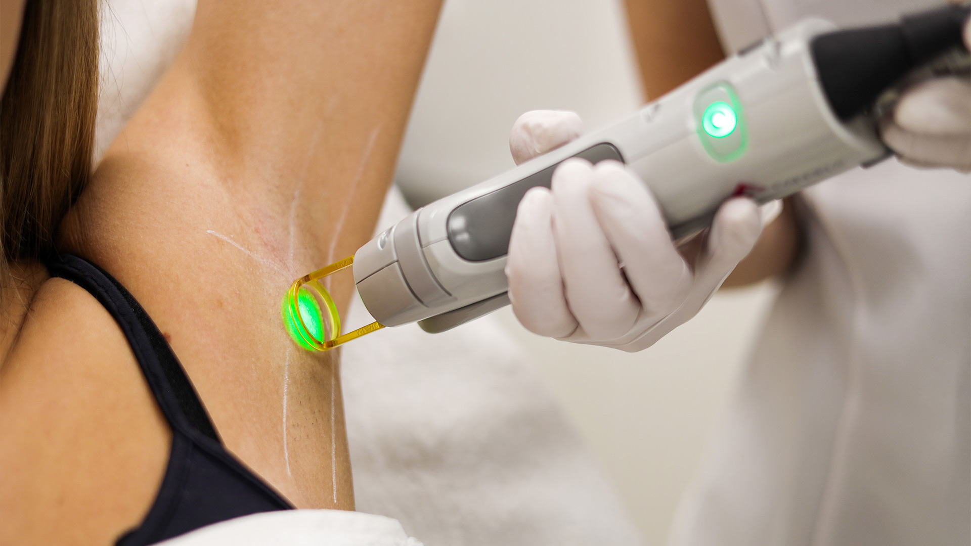 IPL behandeling